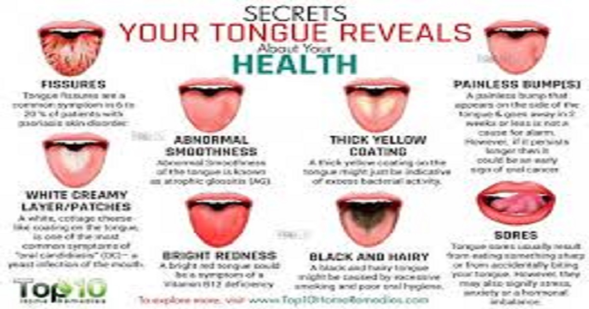 Tongue Health Chart